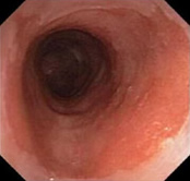 Barrett's Esophagus